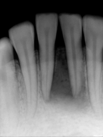 A case of acute exacerbation of  chronic irreversible pulpitis with 31& 41