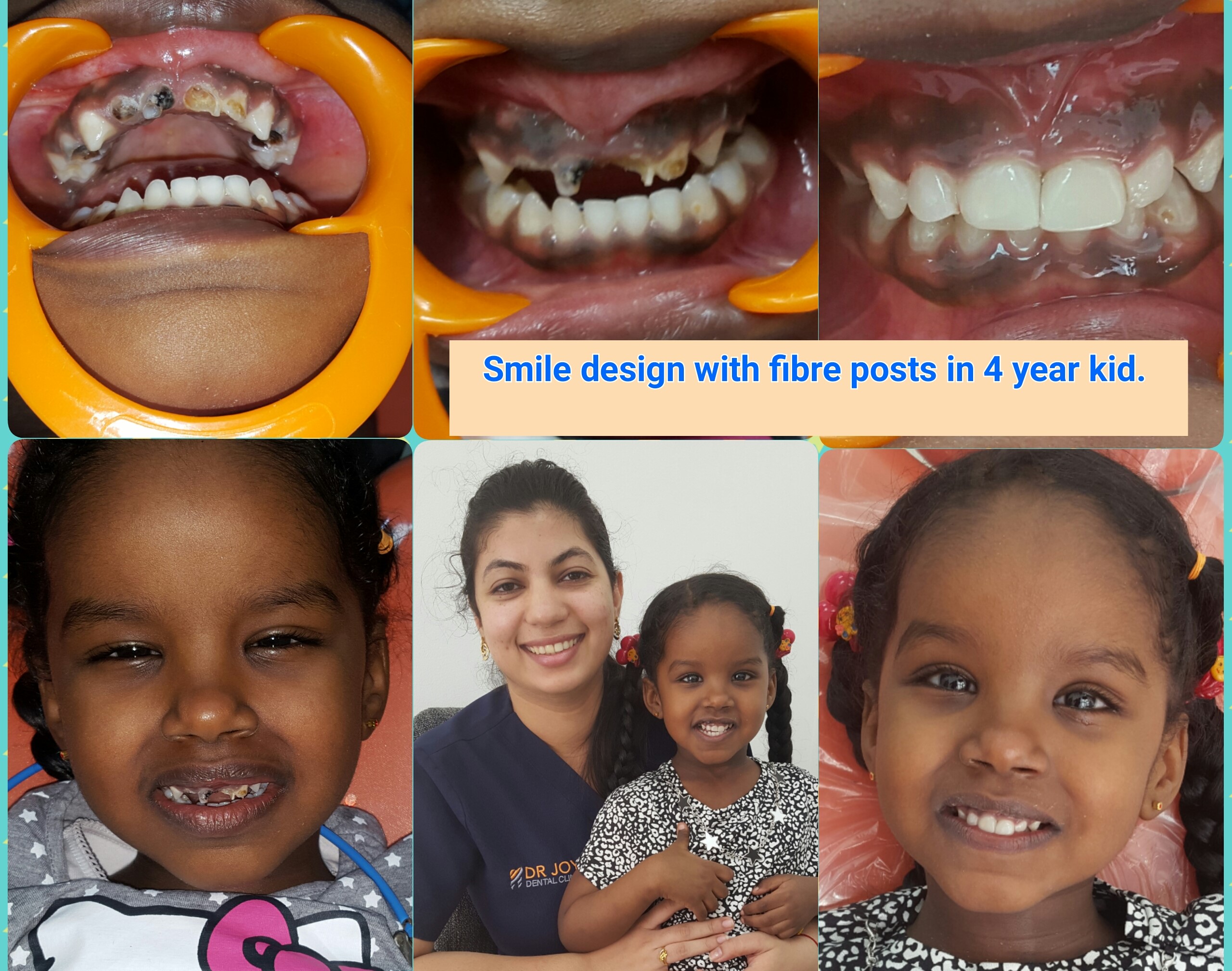 Smile Designing in Young children with Fibre posts.