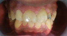 upper and lower veneer and gingivectomy by laser