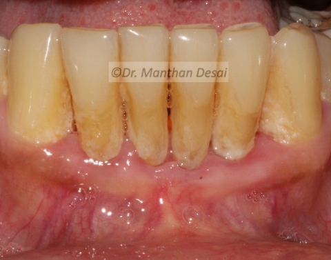 Vestibuloplasty with free Gingival Graft