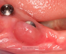 Trouble Shooting in Implantology – Diode Excision
