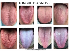 Ayurvedic Tongue Diagnosis in Dentistry