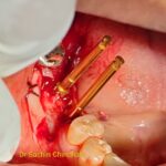 Dental Implant Surgical Placement