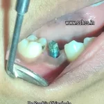 *Immediate Delayed Temporary* on One Piece Dental Implant
