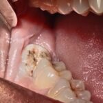 Wisdom Teeth Disimpaction