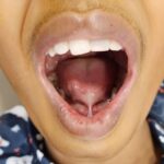 Ankyloglossia – Tongue tie Release
