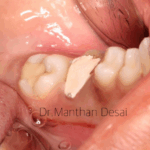 Crown Lengthening – Second chance to Life