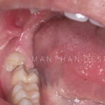 Disimpaction of Horizontal Third Mola