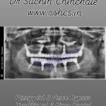 Follow up All on 4, 5 Full Mouth Dental Implant Follow-up OPG 3yr