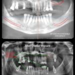 Same Visit Fixed Teeth (SVFT) International Patient