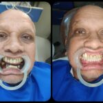 Same Visit Fixed Teeth on Dental Implants