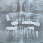 Flapless 3 Piece Root Form Dental Implant Placement*