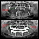 All on 4 Dental Implant Fixed Teeth