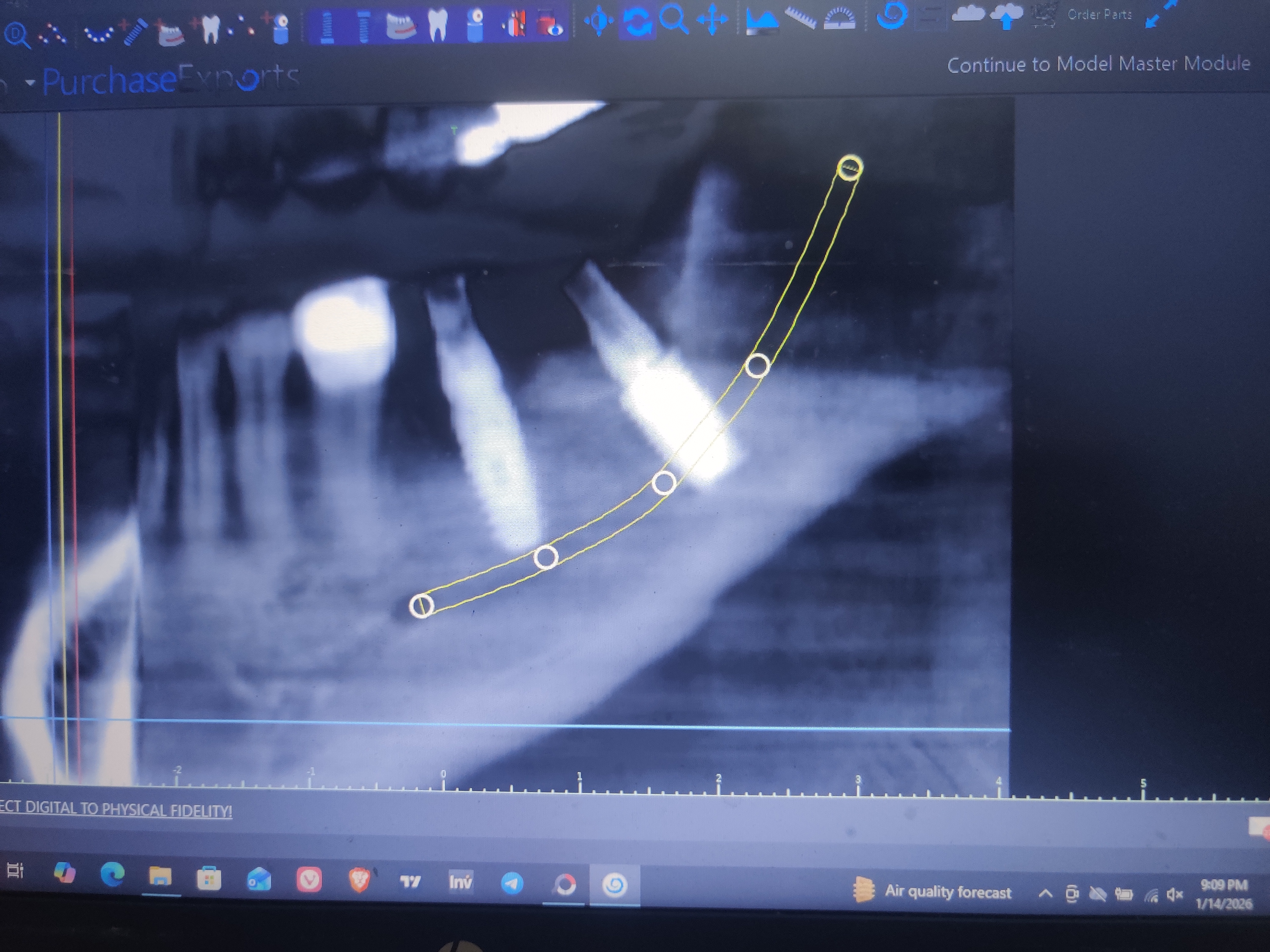Inferior Alveolar Nerve Bypass Post Operative 3D CBCT analysis ...