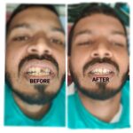 Same Visit Fixed Tooth (SVFT)