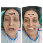 Dental Implant Supported Overdenture Case: Step 2