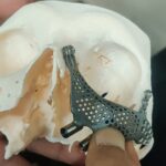 Patient Specific dental implants