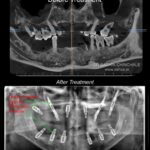 Zygoma, Pterygoid and same visit fixed teeth