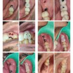 Prosthetic Phase Dental Implants