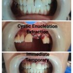 Cystic Enucleation and Immediate Temporaries