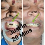 Missing Teeth to Fix Teeth in Just 20 Mins