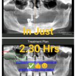 Flapless Full Mouth Dental Implants