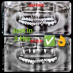 Flapless Full Arch Dental Implants & Immediate Teeth same appointment
