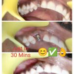 Dental Implant Same Visit Fixed Teeth (SVFT) without any prior 3D CBCT analysis