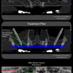 Bilateral Zygoma, Pterygoid, Root Form Dental Implants Placement