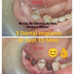 Superfast Dental Implantology
