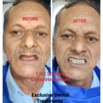 Superfast Complete Denture Technique