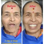 One Hour/ Two Visit Complete Removable Denture Technique