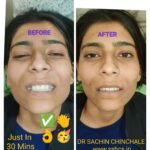 Same Visit Fixed Teeth After Immediate Dental Implant