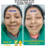 Same Visit Fixed Teeth After Immediate Dental Implant