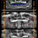 Radiological Pre and Post Operative One Piece Full Arch Dental Implants Case Pre