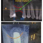 Sinus Graft & immediate Dental Implant Case Presentation