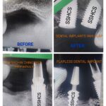 Dental Implants in Grafted Sinus