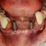 Immediate Teeth after dental implant