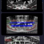 Same Visit Fixed Teeth Radiographic Images