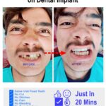 Same Visit Fractured Tooth to Permanent New Fixed Tooth