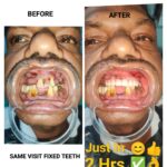 No Teeth to Fixed Teeth in Just 2 Hrs