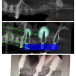 Less Bone Volume, Density & Immediate Drilless, Flapless Dental Im