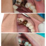 Dental Implant inBadly Carious Tooth to Fixed permanent Dental Implant s 10 Mins