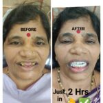 Immediate Flapless Dental Implant & Immediate Temporary Teeth