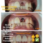 Badly Carious Tooth to Fixed Permanent Dental Implant in Same Visit