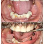 One Piece Hybrid Dental Implants