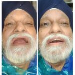 Dental Implant Supported Overdentur to Fixed Prosthesis