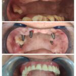 Same Visit Fixed Teeth ( SVFT)