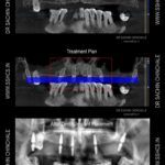 Same visit fixed teeth radiographs