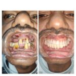 40 Days Later D3, D4 bone Same Visit Fixed Teeth (SVFT) Follow up